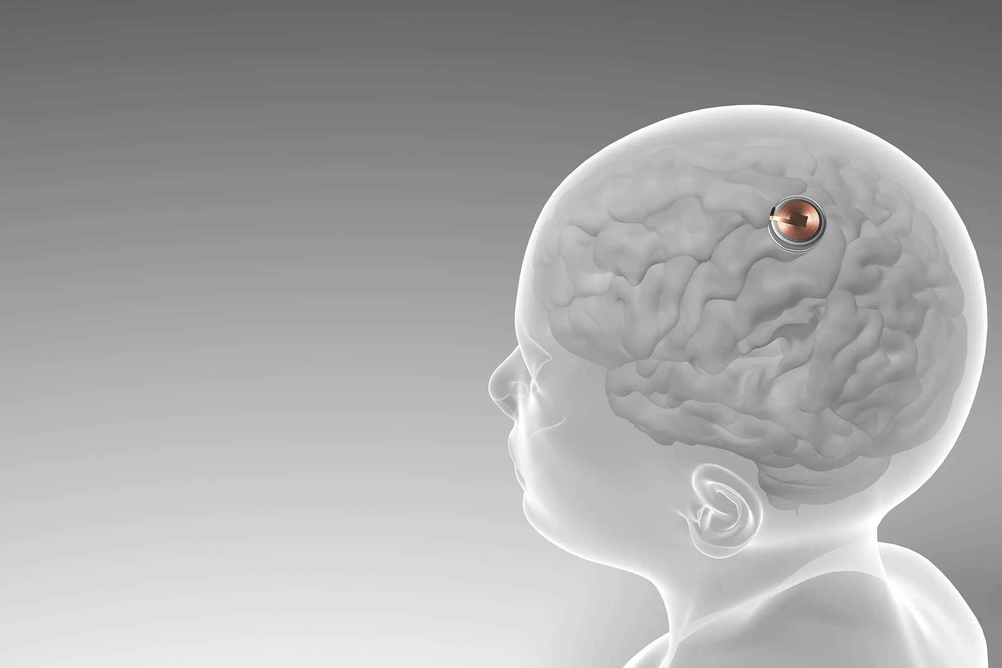 Neuralink's Pioneering Patient Stays Optimistic Despite Challenges in Brain-Implant Trial